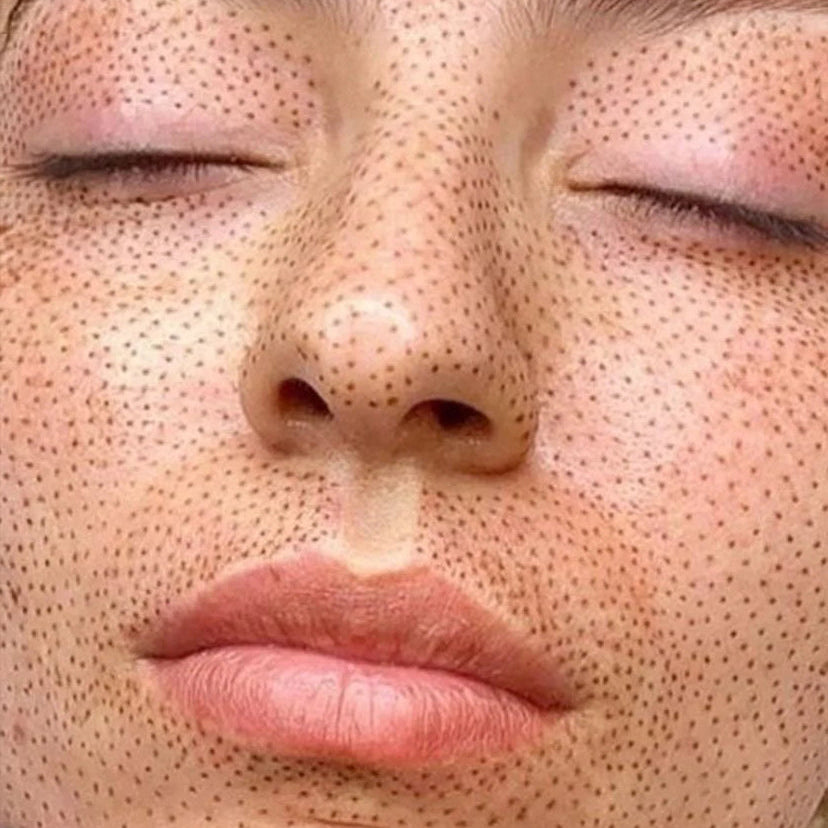 Fibroblast Full Face Rejuvenation