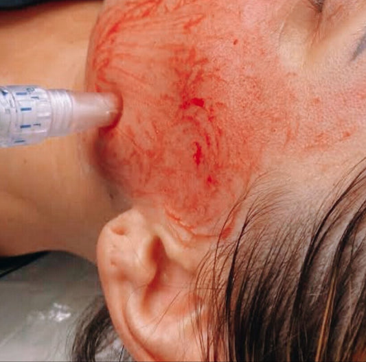 Vampire Facial