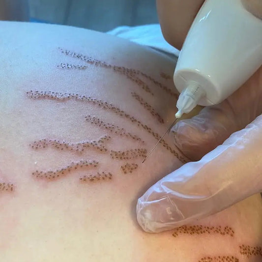 Fibroblast stretch marks