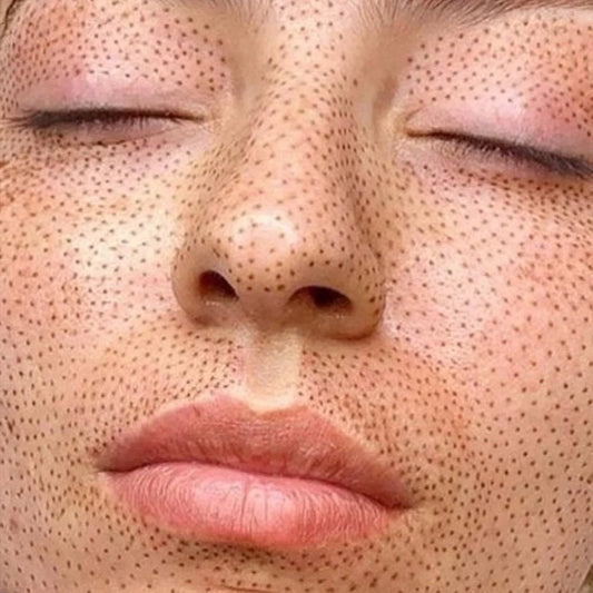 Fibroblast Full Face Rejuvenation