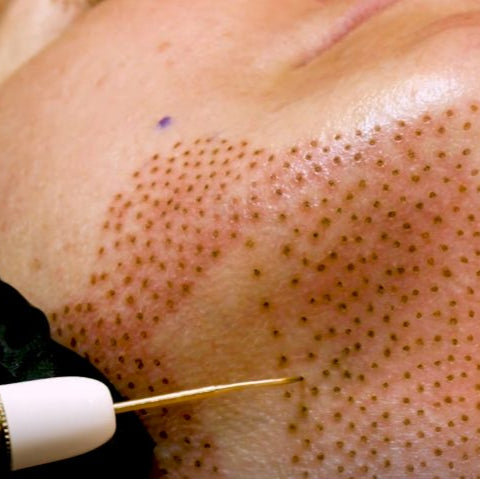 Fibroblast Neck Skin tightening