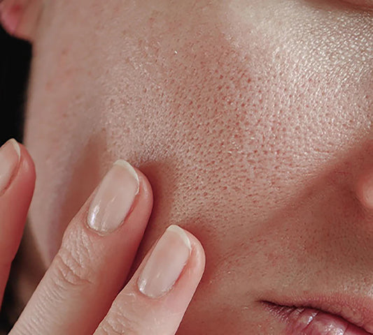 Enlarged Pores Treatment