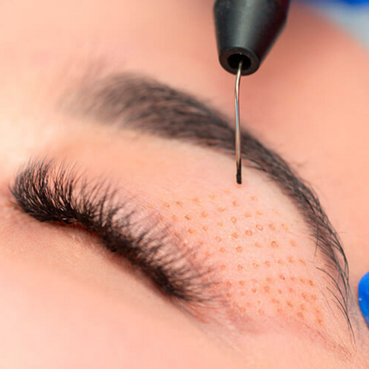 Fibroblast Skin Tightening – Per Area