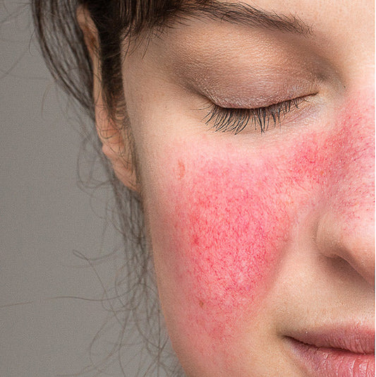 Rosacea Facial
