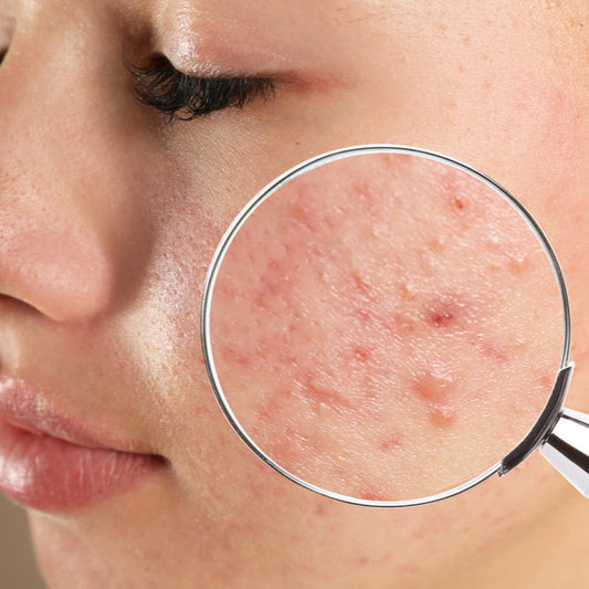 Acne Treatment